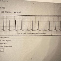 An atrial dysrhythmia originates from